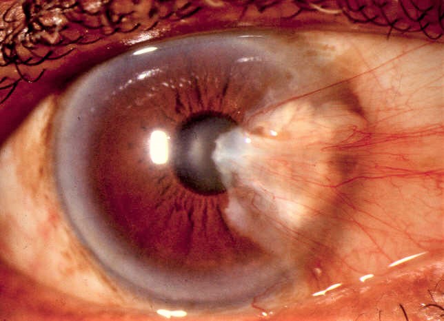 2b.Pterygium