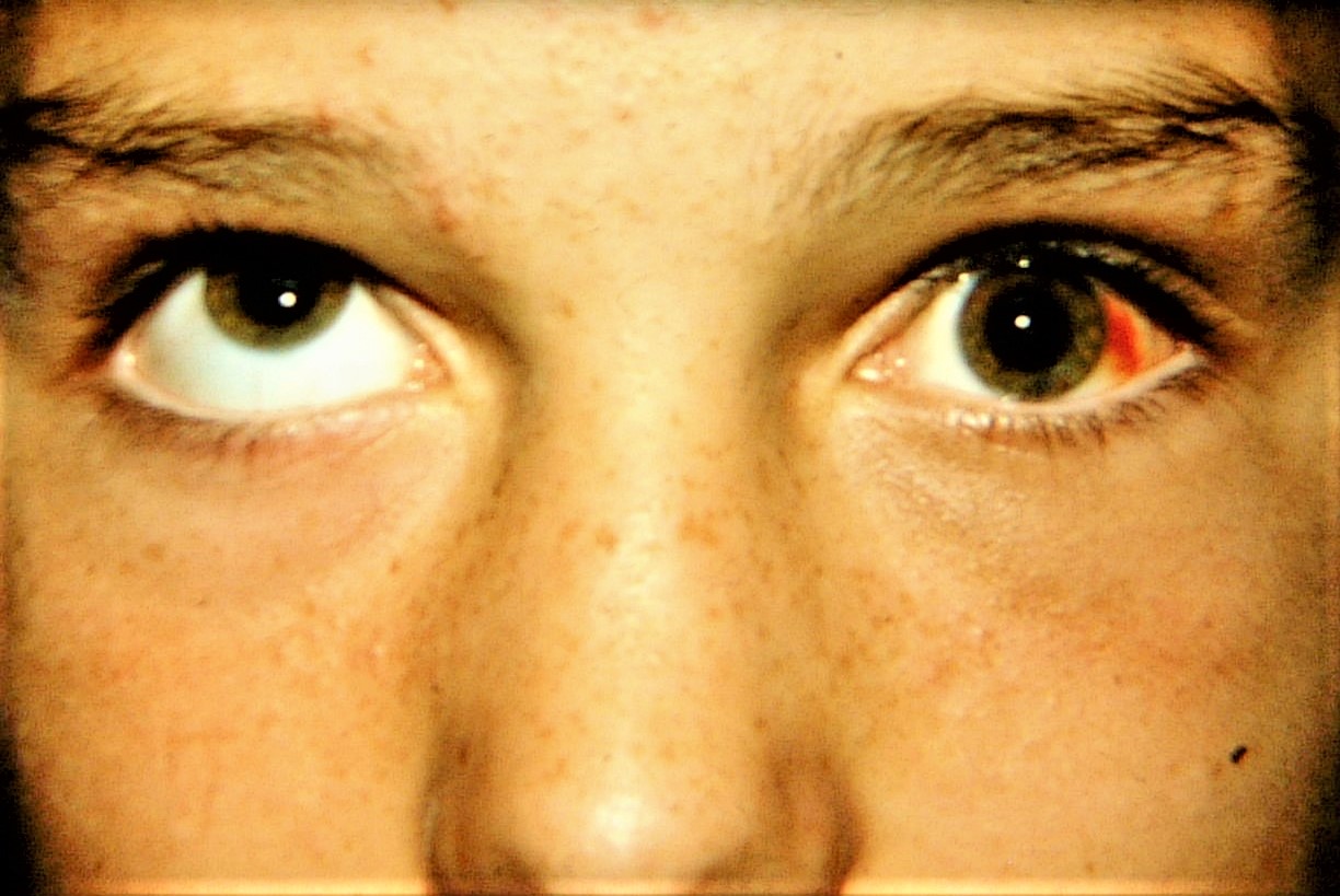 Blow out fracture on left side